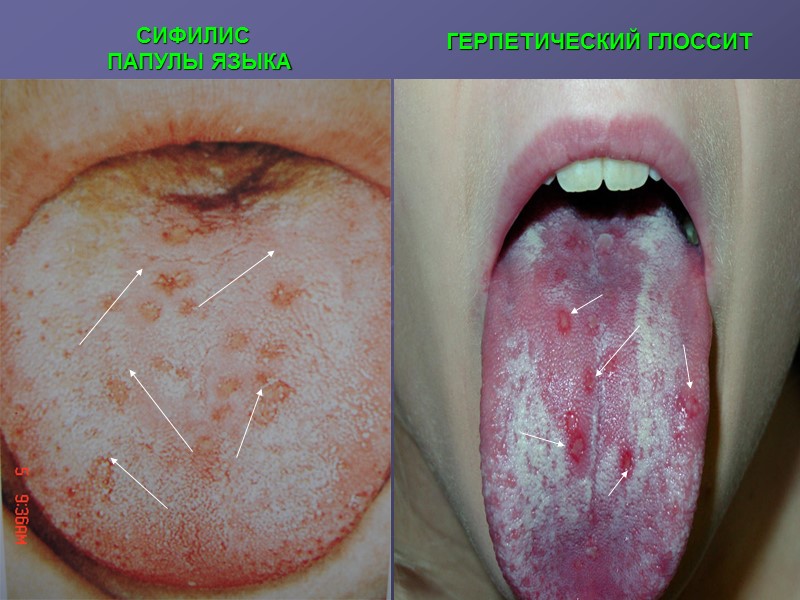 СИФИЛИС   ПАПУЛЫ ЯЗЫКА ГЕРПЕТИЧЕСКИЙ ГЛОССИТ